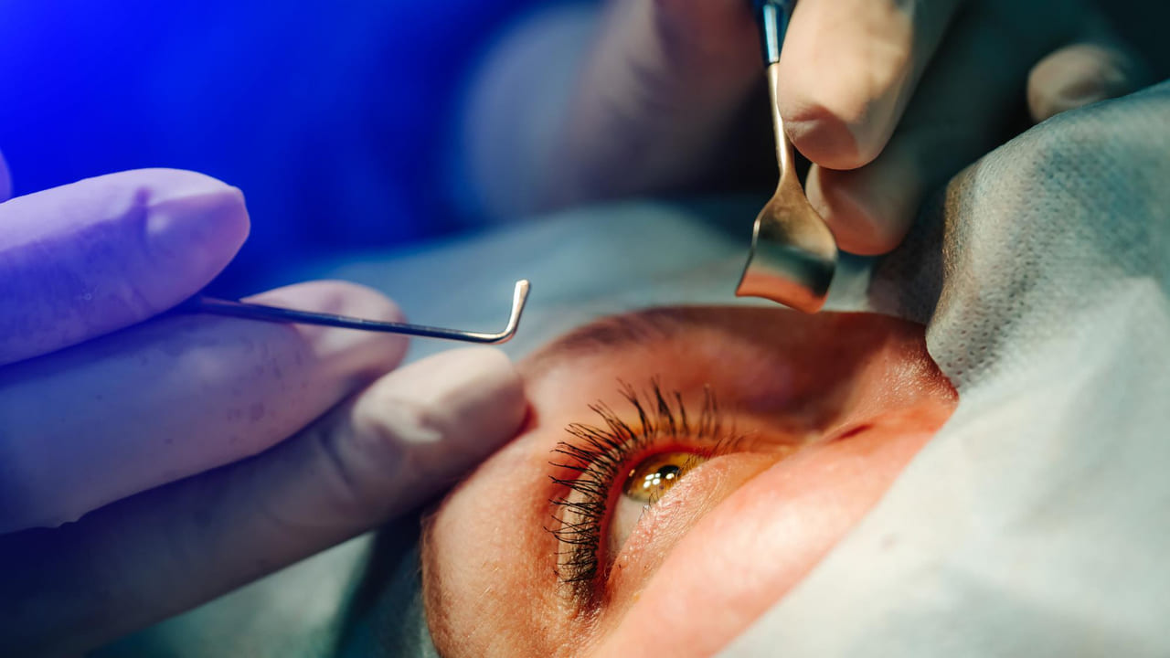 Intervento cataratta
